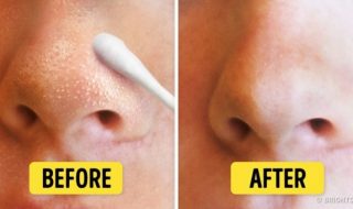 natural ways to remove blackheads and whiteheads