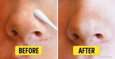natural ways to remove blackheads and whiteheads